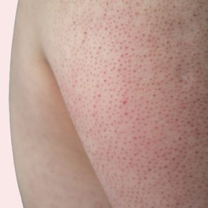 La kératose pilaire