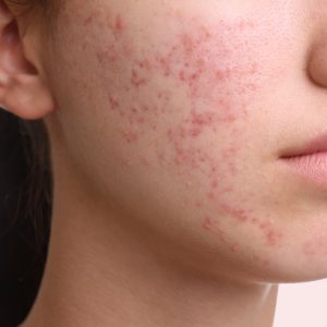 acné hormonale