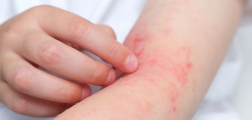 Peau atopique : comprendre, apaiser et rééquilibrer durablement la peau