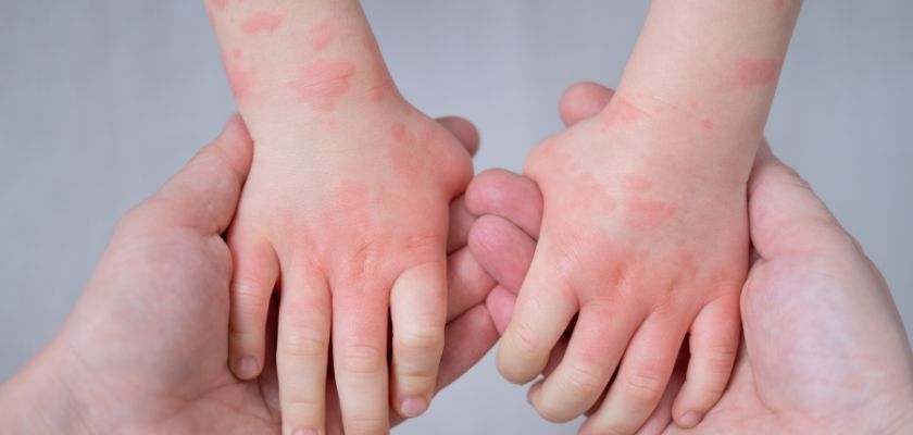 Eczéma chez le bébé et l’enfant : comprendre, reconnaître et apaiser la peau en douceur